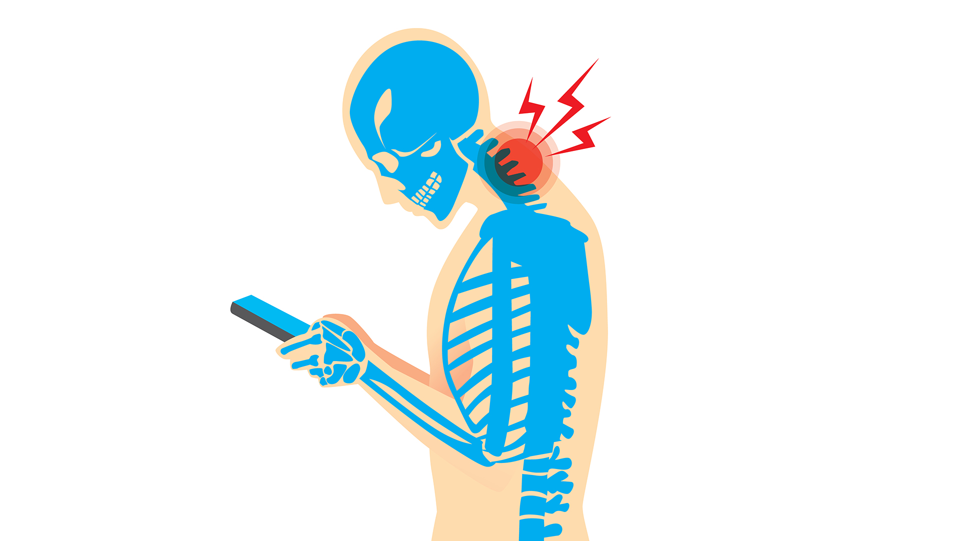 Sindrom “Text Neck”: Penyebab, Gejala, dan Cara Mencegahnya