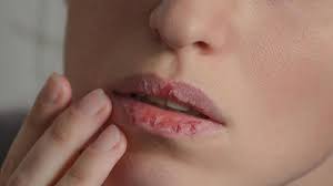 Kenapa Bibir Sering Pecah-Pecah Meski Sudah Minum Air?